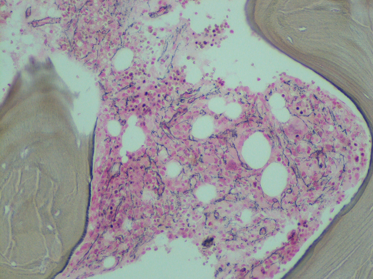 Bone marrow biopsy: Reticulin stain